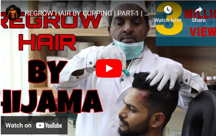 REGROW HAIR BY CUPPING | PART-1